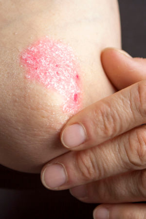 Psoriasis (Schuppenflechte), eine Erkrankung der Haut
